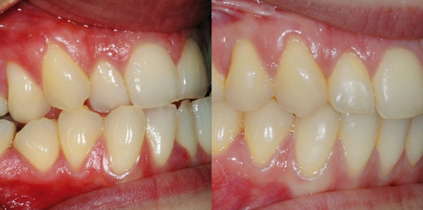 Die kieferorthopädische Behandlung erwachsener Patienten