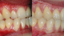 Die kieferorthopädische Behandlung erwachsener Patienten