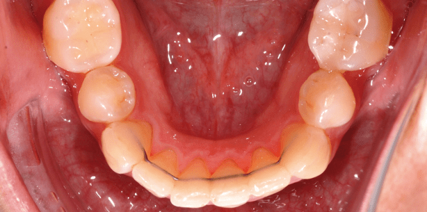 ASR: Wo liegen die Grenzen?