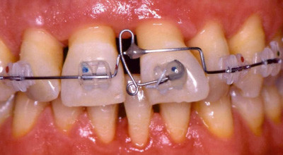 Kieferorthopädie und parodontale Ästhetik