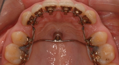 Gaumenimplantate in der Lingualtechnik