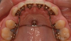 Gaumenimplantate in der Lingualtechnik
