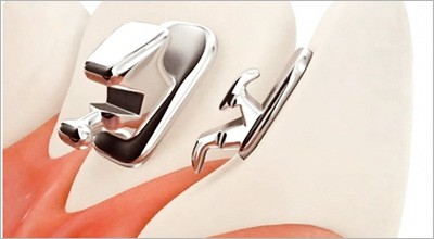 Neue linguale Straight-Wire-Technik
