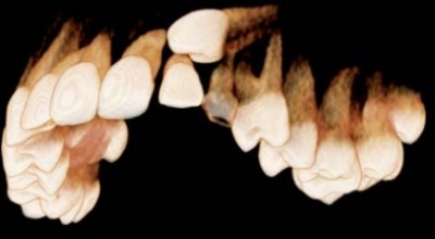 Röntgen in der KFO – analog, digital und 3-D (3)