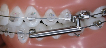 Therapie von Klasse II-Fällen mit dem BioBiteCorrector®