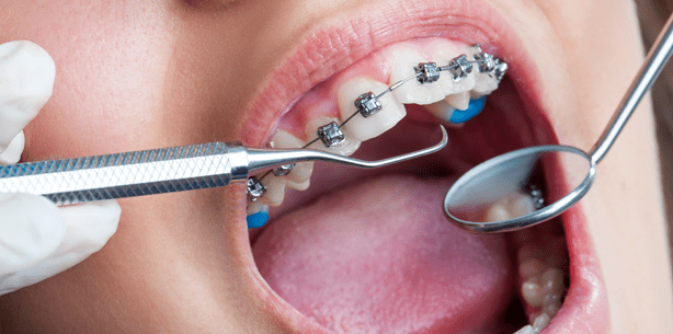 Labial, lingual und digital – Kieferorthopädie auf der IDS 2015