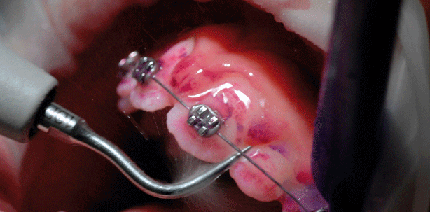 Kieferorthopädie und Prophylaxe – das Erfolgsmodell