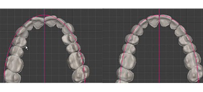 Das „Customized“ Alignersystem