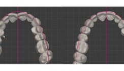 Das „Customized“ Alignersystem