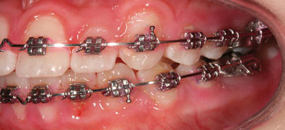 Prophylaxe ist mehr als Zähneputzen