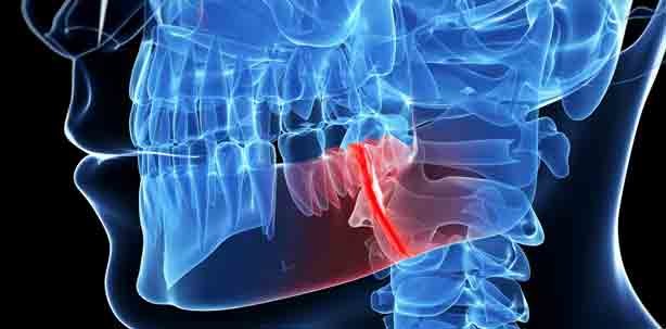 Knochen heilen mit einem künstlichen Gel-Schwamm
