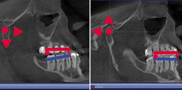 Kieferrelationsbestimmung: Einfach. Eindeutig. Reproduzierbar.