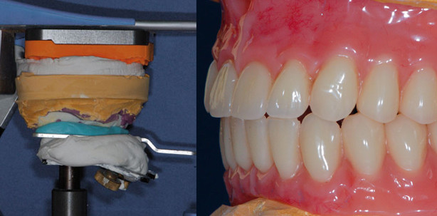 Instrumentelle Funktionsanalyse in der Totalprothetik