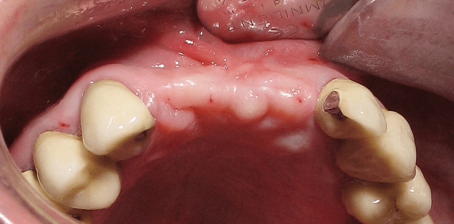 Die laterale Augmentation ­horizontaler Knochendefekte