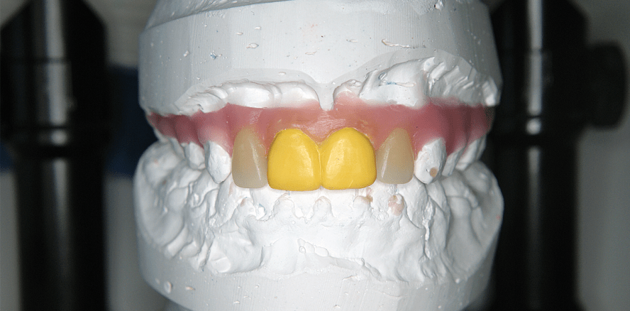 Orale Rehabilitation – kieferortho­pädischer Lückenschluss ja, nein?