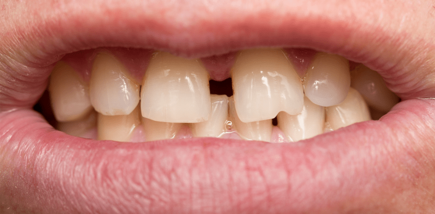 Hormone können Bissprobleme verursachen