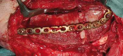 Mikrochirurgisch anastomosiertes ­Becken­kammtransplantat als Implantatlager