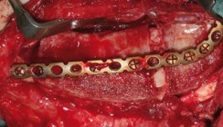 Mikrochirurgisch anastomosiertes ­Becken­kammtransplantat als Implantatlager