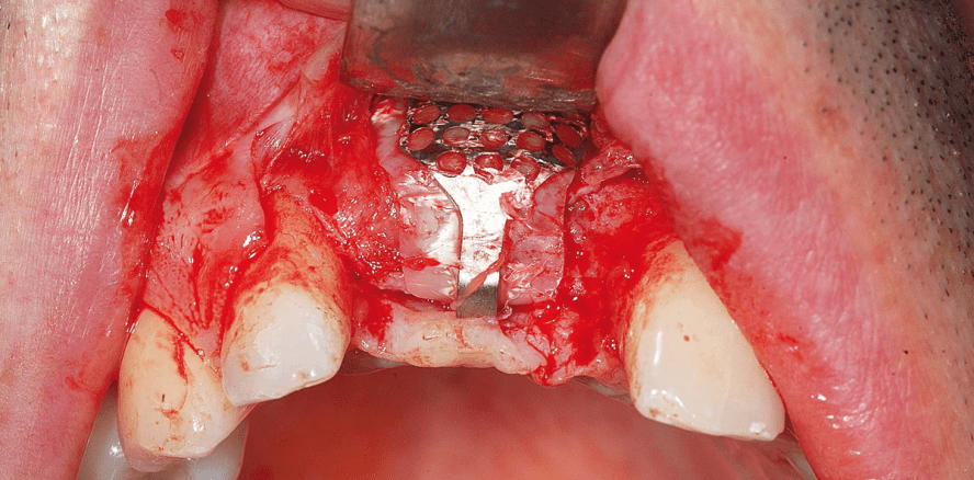 Vertikale Kieferkammaugmentation und Implantation in der mittleren Oberkieferschneidezahnregion