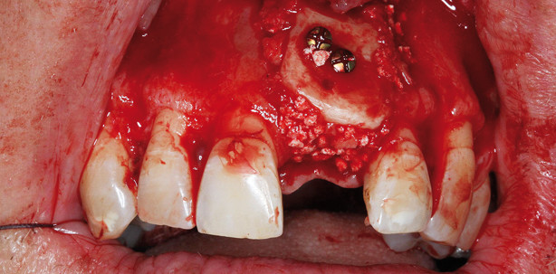 Korrektur mittlerer Kieferkammdefekte mittels Transplantaten
