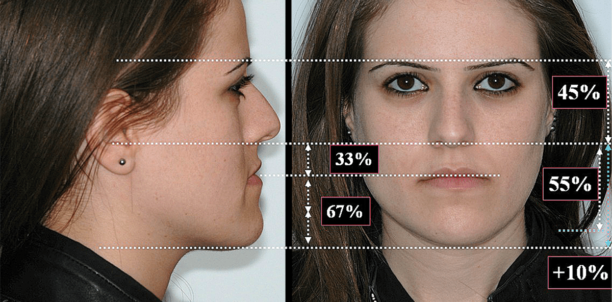Kombinierte kieferorthopädisch-kieferchirurgische Behandlung: Wirkung skelettaler Veränderungen auf Weichteilstrukturen