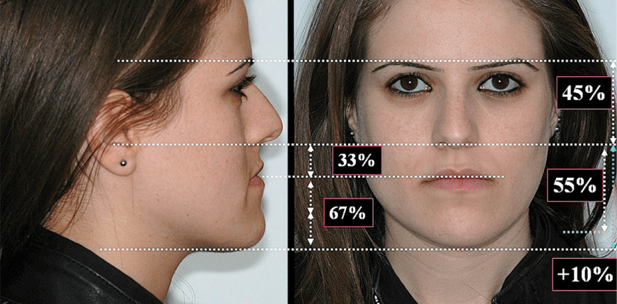 Kombinierte kieferorthopädisch-kieferchirurgische Behandlung: Wirkung skelettaler Veränderungen auf Weichteilstrukturen