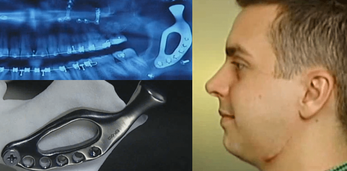 Dank 3-D-Druck: Mann erhält künstliches Kieferteil