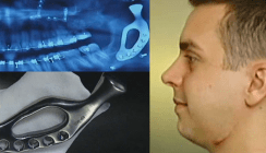 Dank 3-D-Druck: Mann erhält künstliches Kieferteil