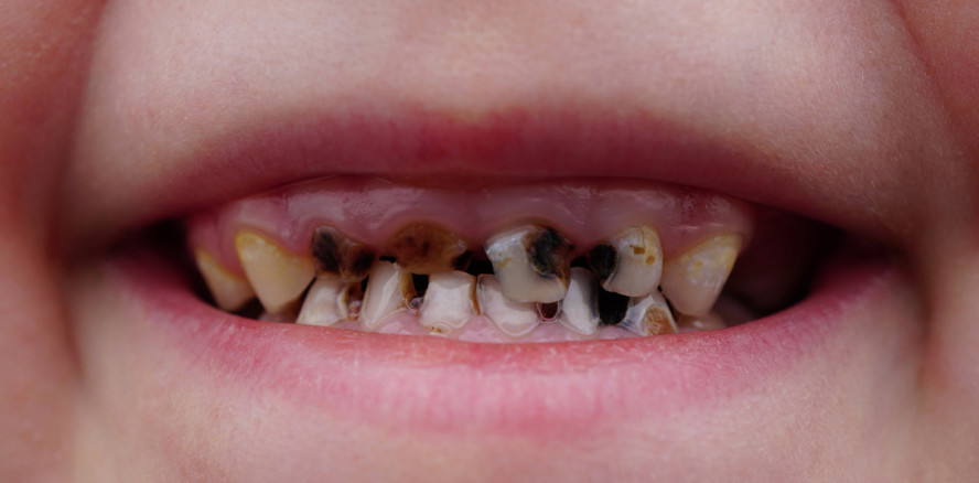 Dauernuckeln von „Quetschies“ führt zu Karies