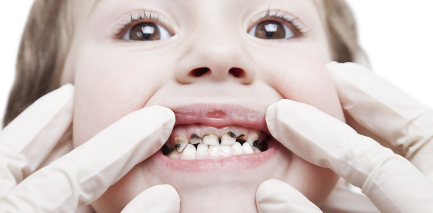 Neurodermitis bei Babys erhöht das Kariesrisiko