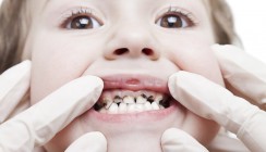 Neurodermitis bei Babys erhöht das Kariesrisiko