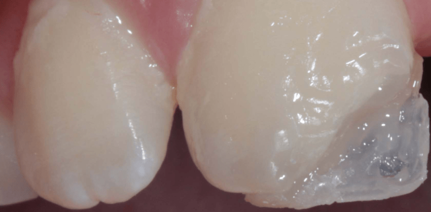 Ästhetische Frontzahn­rekonstruktion im kindlichen Gebiss mittels Komposit