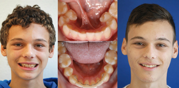 Kieferorthopädie heute: Ästhetisch und gesund beginnt im Kindermund