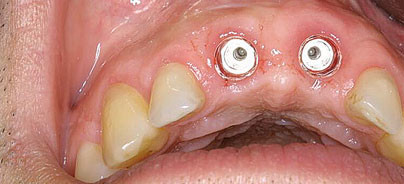 KISS-Prinzipien der Ästhetischen Implantologie