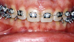 Behandlung von Klasse II-Dysgnathien