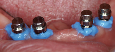 Sicheres Einkleben von Attachments