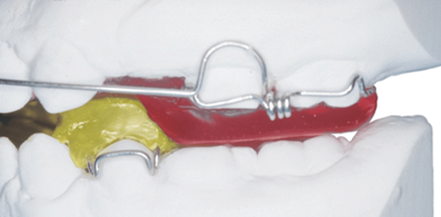 Berechnungsfähig ist nicht gleich erstattungsfähig!