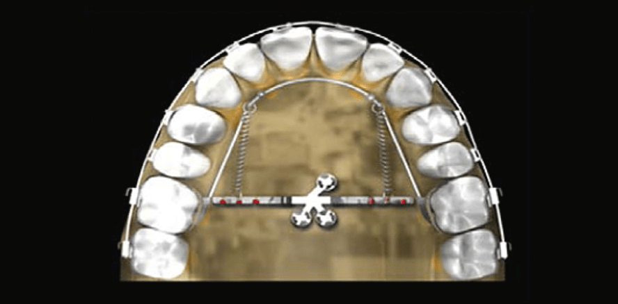 Klinische und biomechanische  Aspekte rund um TADs