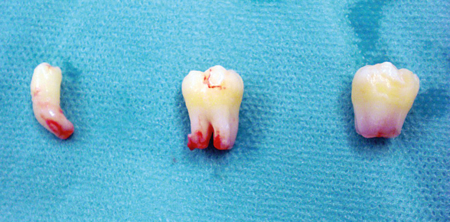 Die autologe  Zahntransplantation