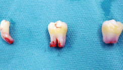 Die autologe  Zahntransplantation