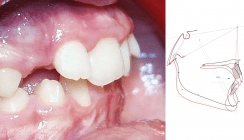 Effizienz ligaturenfreier Brackets – ein Zwillingsvergleich