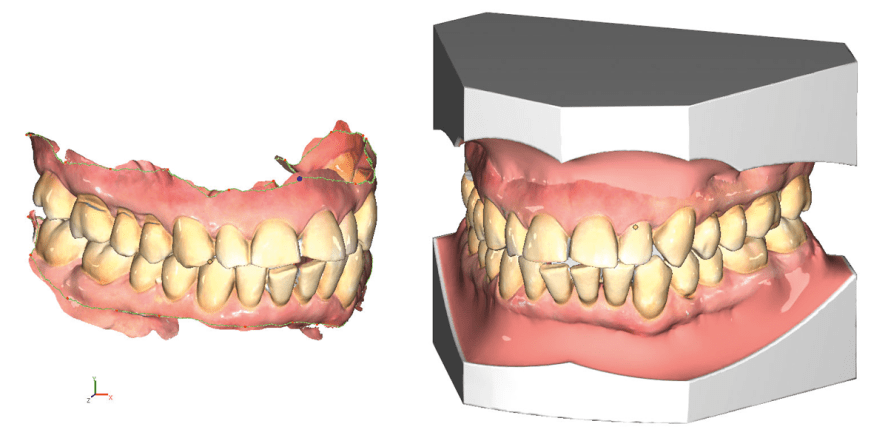 Digitale Modelle in der Praxis: diagnostische Vermessung