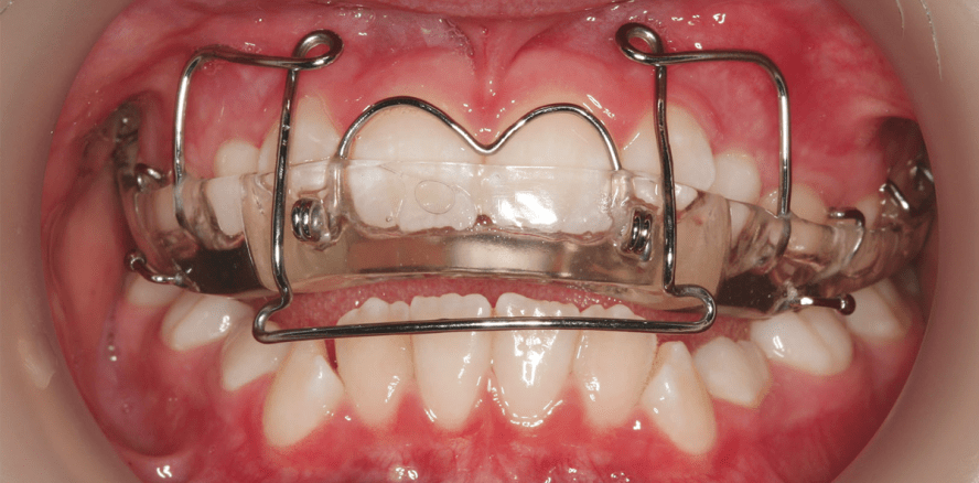 Frühbehandlung bei Klasse III mit GNE und Protraktion