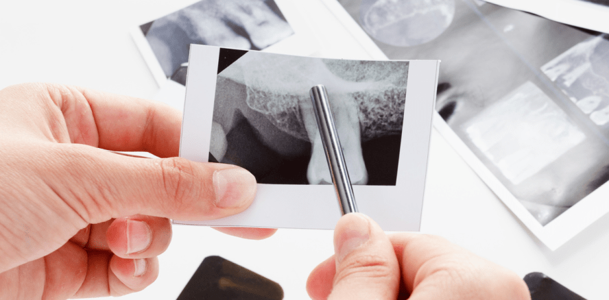 Knochenverlust bei Parodontitis: Kleines Protein mit großer Wirkung