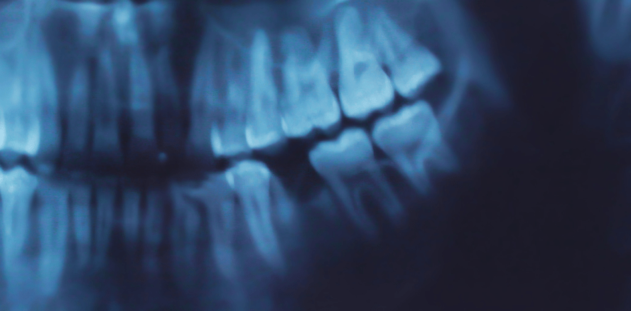 Gel soll Kieferknochen nach Zahnextraktion wiederherstellen