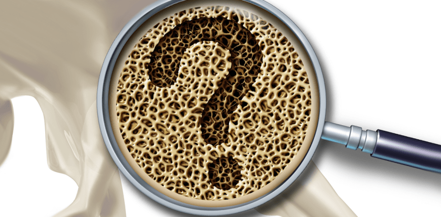 Osteoporose: Auch Störungen im Immunsystem spielen wichtige Rolle