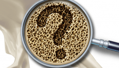 Osteoporose: Auch Störungen im Immunsystem spielen wichtige Rolle
