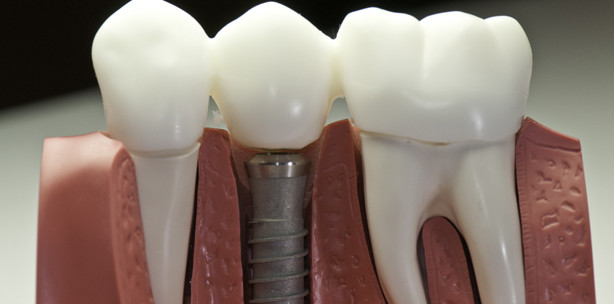 Maßnahmen zum Knochenaufbau