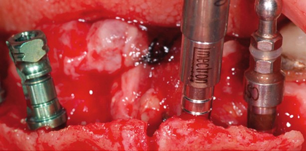 Knochenaugmentation komplexer Defekte