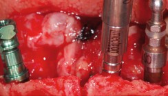 Knochenaugmentation komplexer Defekte